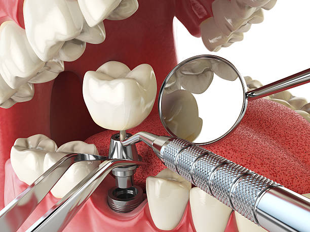 Best Emergency Denture Repair in Sunriver, OR